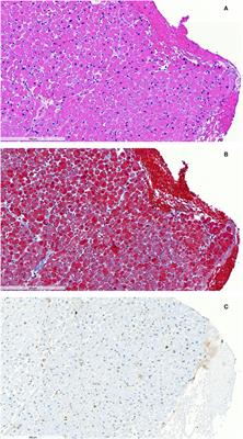Case Report: Steroid-Responsive <mark class="highlighted">Takotsubo Cardiomyopathy</mark> Associated With Cytokine Storm and Obstructive Shock